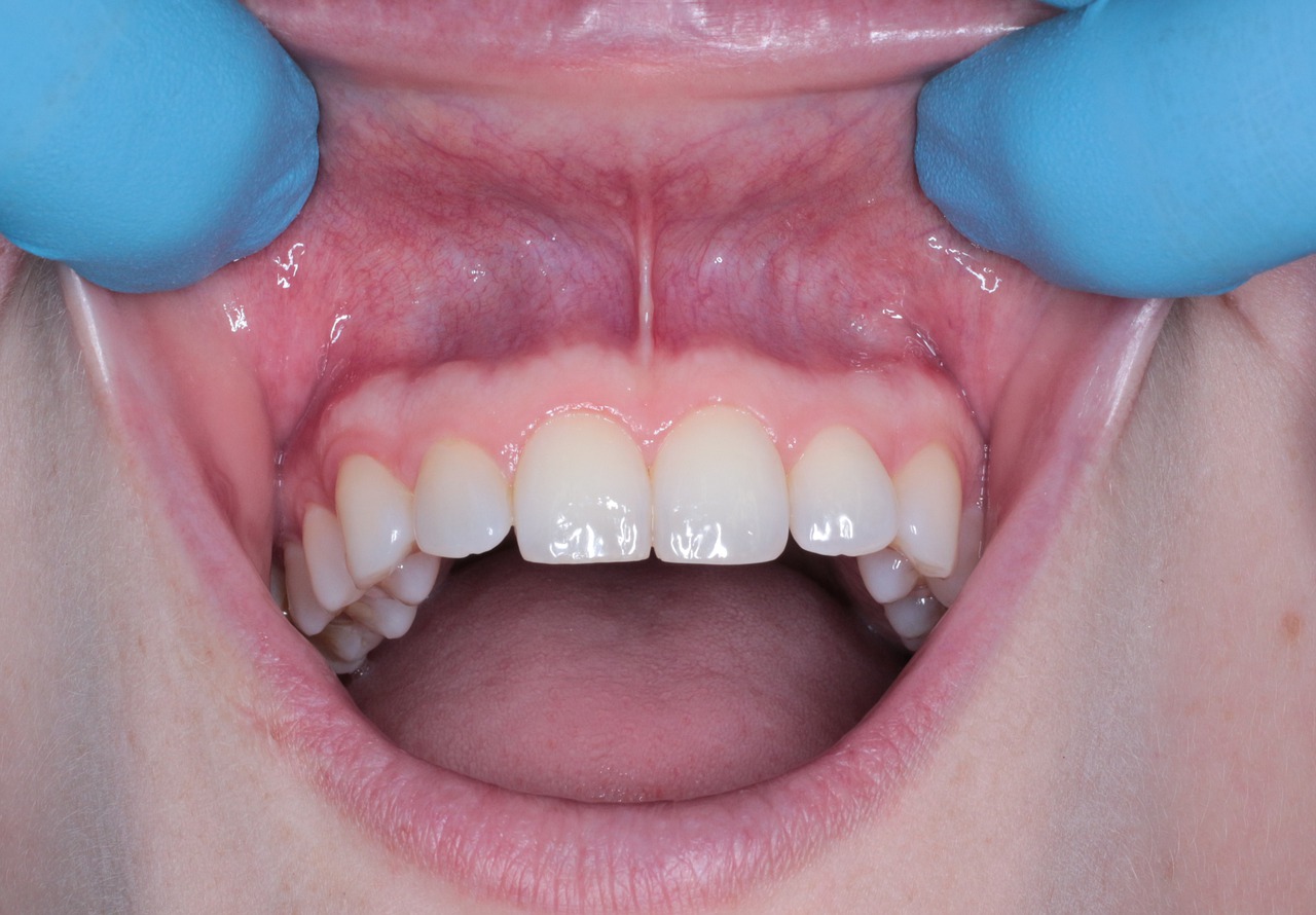 Co znamená v dentální hygieně pojem Airflow?
